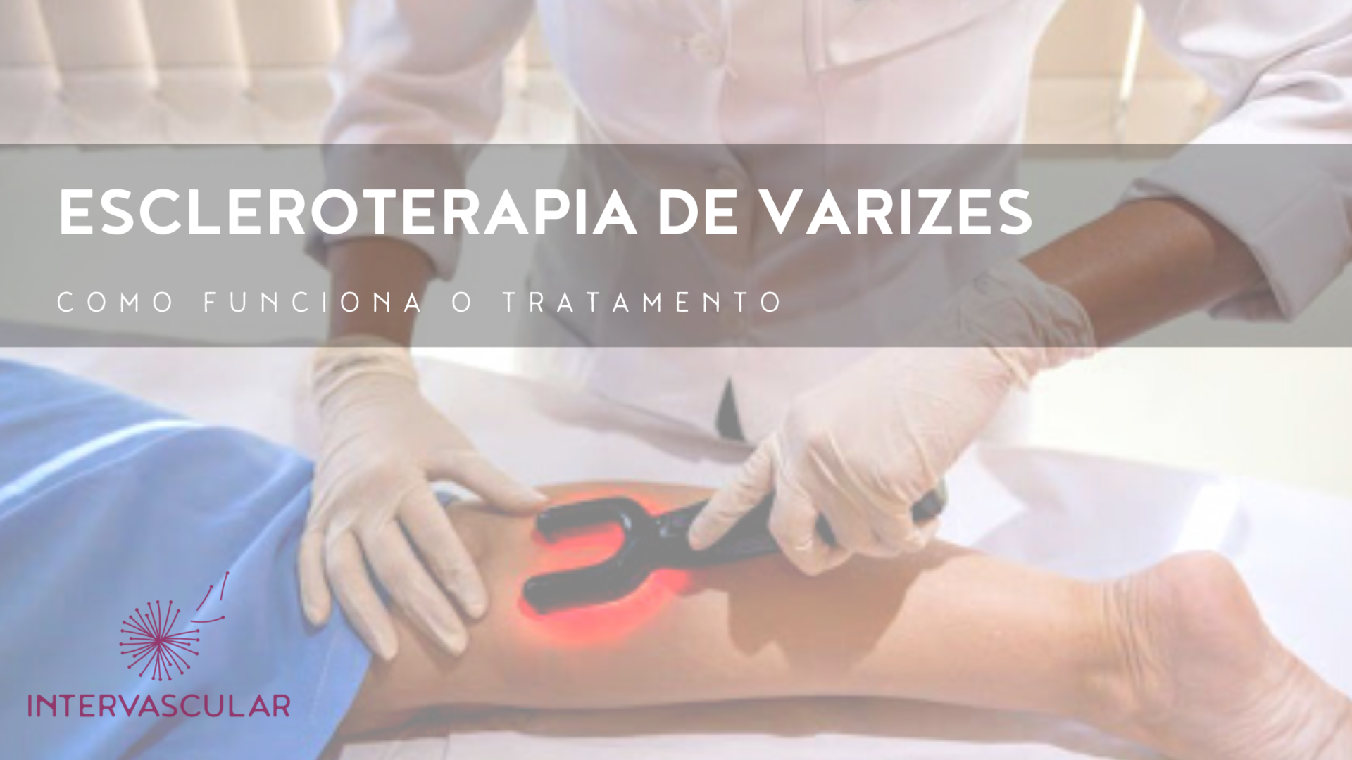 Escleroterapia De Varizes – Como Funciona? – Intervascular